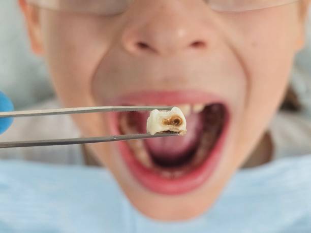 Best Emergency Tooth Extraction in Freeport, FL